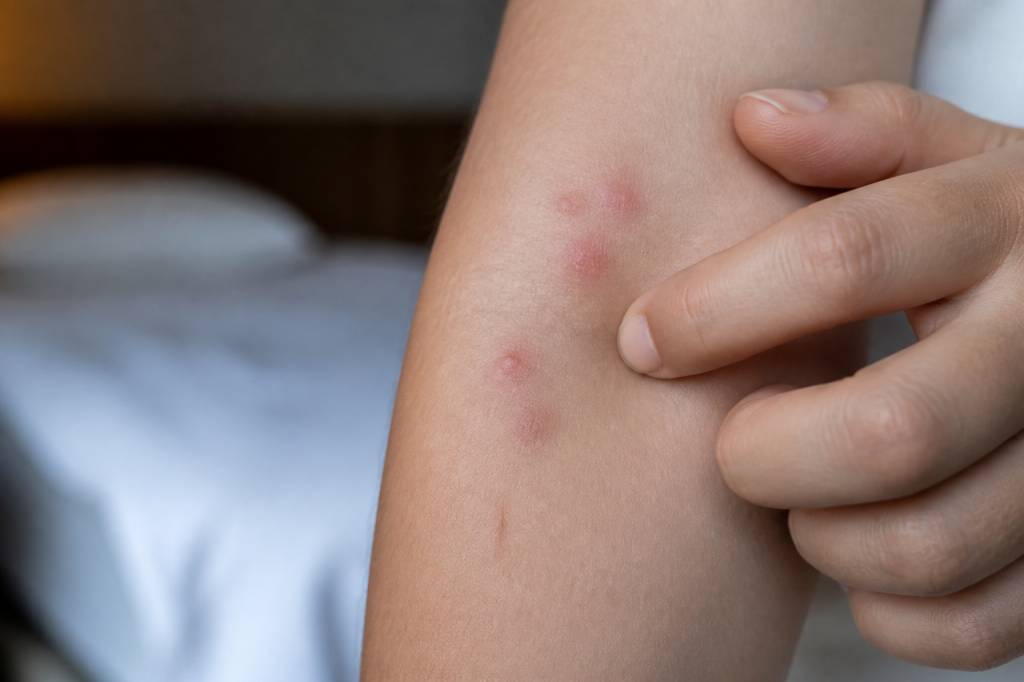 Punaise de lit morsure : reconnaître les symptômes et agir efficacement en Rhône-Alpes