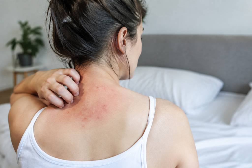 Piqure d&rsquo;acariens : symptômes, causes et solutions pour s&rsquo;en débarrasser