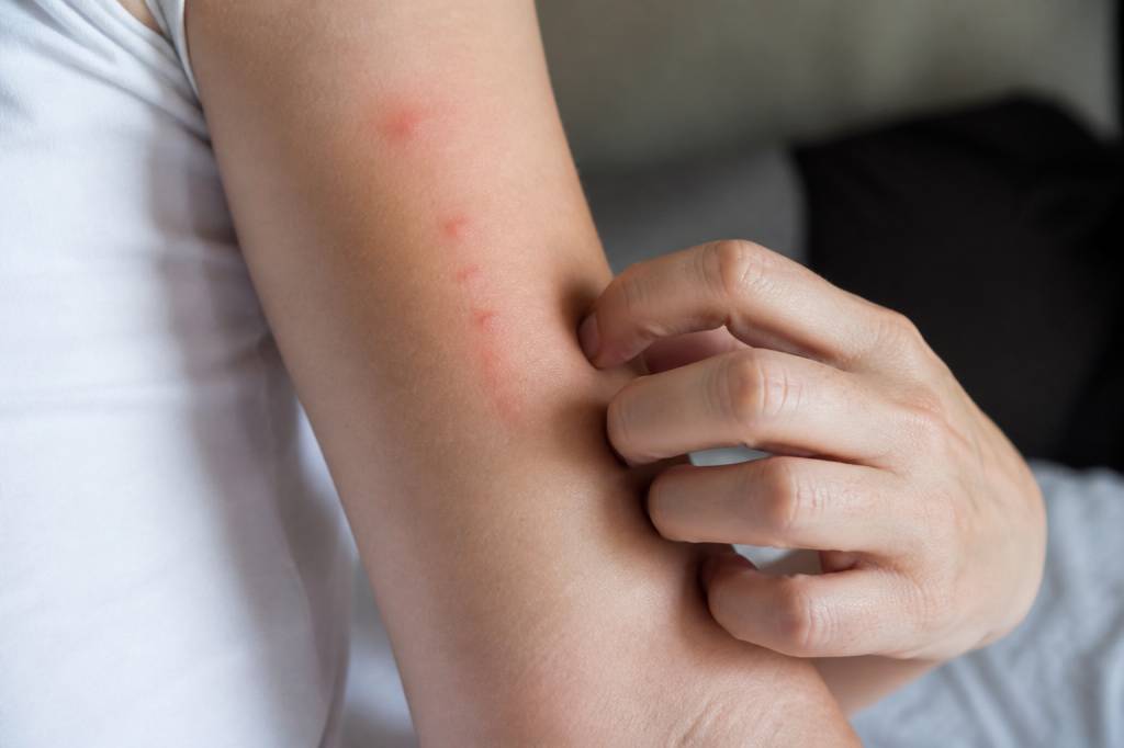 Piqure de punaise de lit symptome : comment les reconnaître et agir efficacement